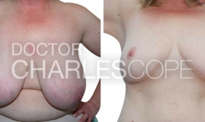 Breast reduction with Dr Cope, before & after gallery 178