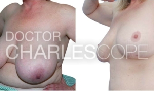 Gallery image 179, breast reduction and lift surgery, Dr Charles Cope