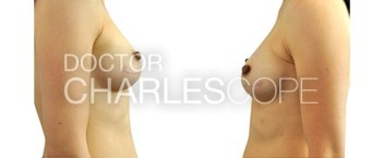 Breast Reconstruction – 6