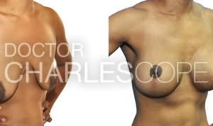Breast augmentation with mastopexy patient, before and after photo 218-1