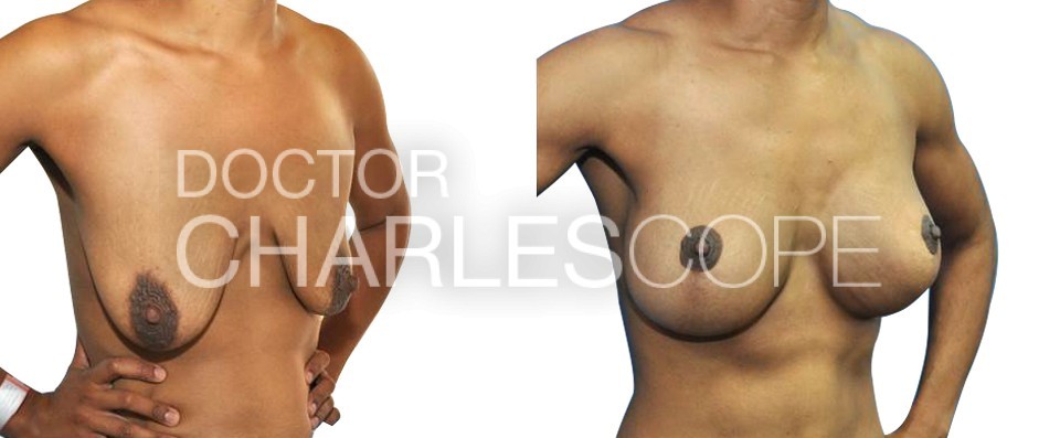 Breast Augmentation with Breast Lift (Mastopexy) – 5