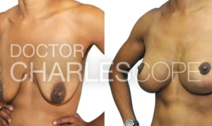 Breast augmentation and lift surgery patient (after fed 5 children), before & after photo 219-1