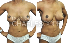 Breast & abdominal surgery – 12