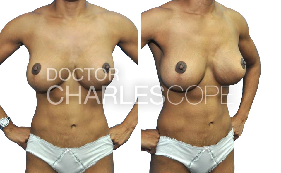 Mummy Makeover patient, before & after surgery, Dr Cope 221
