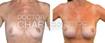 Breast Reconstruction – 7
