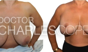 Dr Cope, breast reduction gallery, photo 260