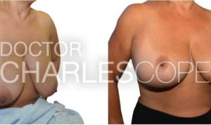 Breast lift and small reduction, before & after gallery 261