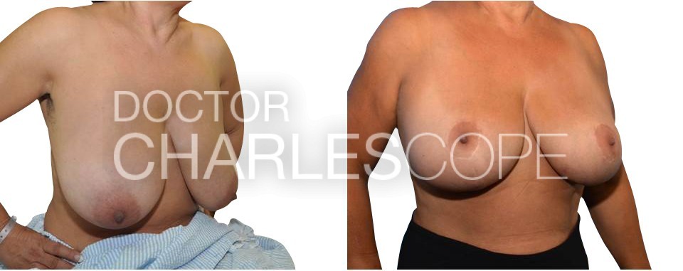 Breast Reduction Surgery Sydney & Gosford – 6