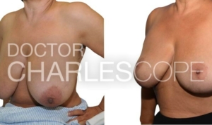 Patient before & after breast lift and small breast reduction, photo 262