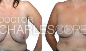 Breast reduction patient (G cup to D cup), gallery photo 273