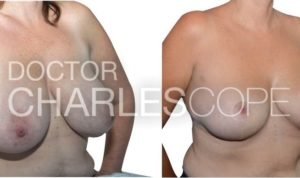 Breast reduction surgery (G cup to D cup), Dr Cope breast gallery 274