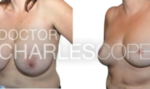 Breast reduction surgery 275