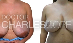 Breast reduction from G cup to DD cup, before & after 282
