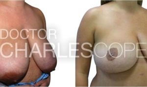 Patient before & after gallery, breast reduction from G cup to DD cup 283