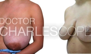 Breast reduction before & after 284, Dr Charles Cope