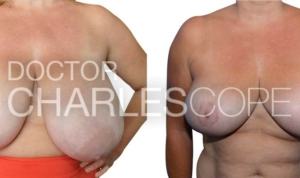 Breast reduction patient, before & after image 285, Dr Charles Cope