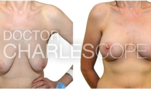 Patient 51yo before and after breast augmentation with lift surgery, photo 291-1