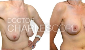 Breast augmentation and mastopexy surgery before & after, 51yo patient 292-1