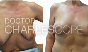 Patient (55yo) before breast augmentation and lift surgery 302-1