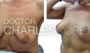 Dr Cope patient (55yo) before and after breast augmentation and lift plastic surgery 304-1