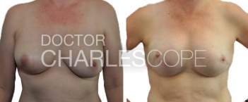 Breast Reconstruction - Before & After – 2