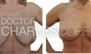 Breast lift and inverted nipple correction before & after, gallery photo 66