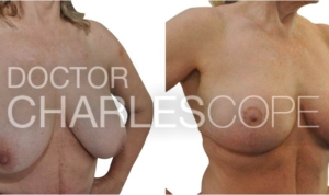 Patient before & after breast reduction & lift, with inverted nipple correction 67