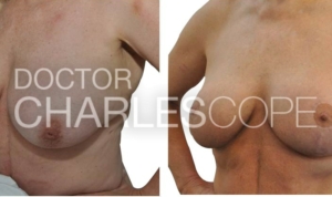 Breast reduction surgery before & after 68, Dr Charles Cope