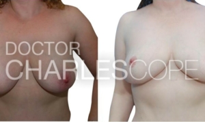 Breast lift (and small reduction, 1 cup) before & after 87, Dr Cope