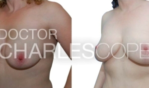 Small breast reduction with lift, before & after gallery 89