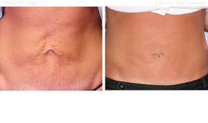 Thermage Skin Tightening Non Surgical – 5
