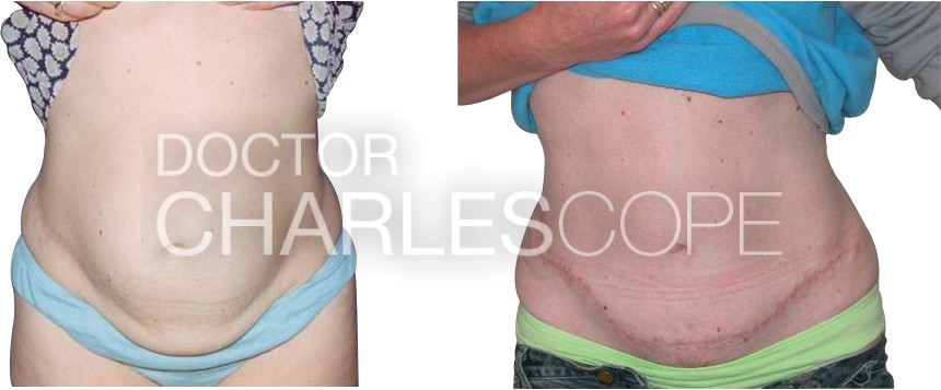 Abdominoplasty before and after, photo 03