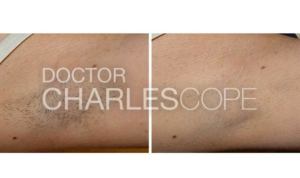 Patient before & after laser hair removal on armpit area 01