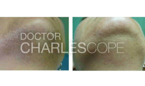 Laser hair removal before & after 02, chin area, Dr Charles Cope