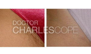 Laser hair removal before and after 03 - bikini area, Dr Cope