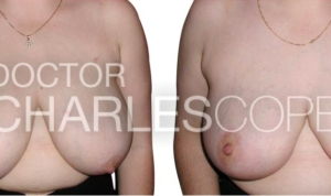 Breast reduction before & after, gallery photo redlift 01