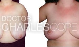 Breast reduction and lift, from G cup to D cup, photo 02