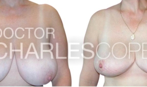 Patient before & after breast reduction and lift surgery 3-1