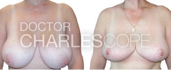 Breast Surgery – 4