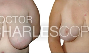 Breast reduction and lift surgery patient 04R, front view