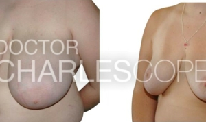 Breast reduction and breast lift before and after 38-2