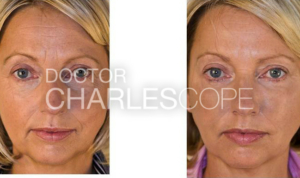 Before & after cheek volumisation treatment photo 35