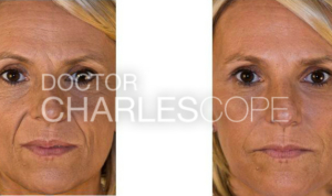 Female patient before and after glabella, nasolabial folds & cheek volumisation (dermal fillers) 36