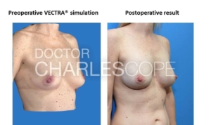 Vectra Breast Augmentation Simulations – 2