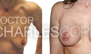 Breast augmentation with lift, Dr Charles Cope, patient 43yo before & after surgery 222-1