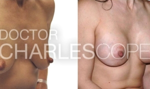 Breast augmentation with lift patient (43yo), before and after, DrCharles Cope 223-1