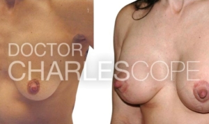 Dr Charles Cope, breast augmentation and lift, patient 43yo before & after procedure (results) 224-1