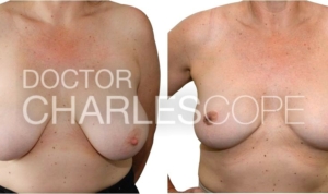 Breast reduction gallery, photo 238, Dr Charles Cope