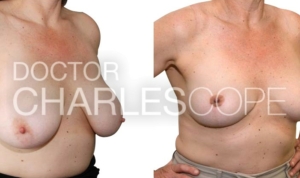 Breast reduction (E cup to C cup) before and after 239