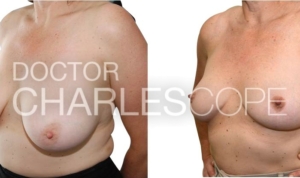 Breast reduction - E cup to C cup, Dr Cope 240